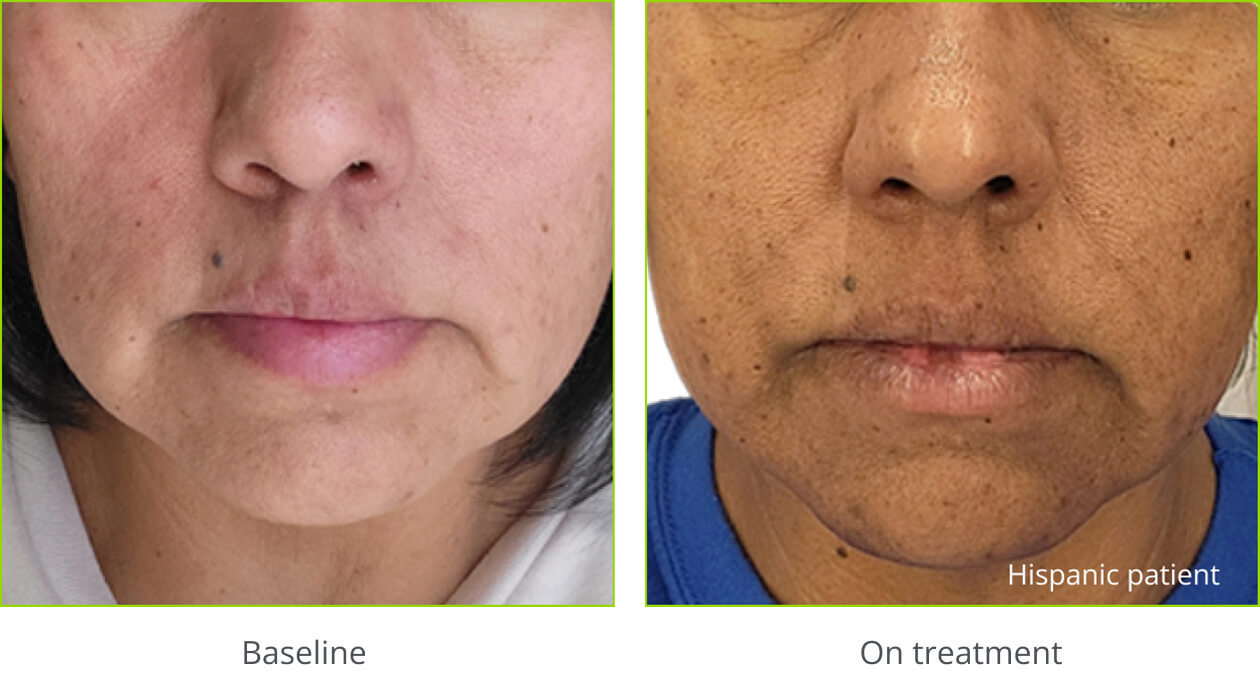 Example of hyperpigmentation